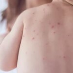 sao-paulo-confirma-mais-dois-casos-de-sarampo-e-total-chega-a-32