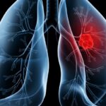 saiba-o-que-e-adenocarcinoma-pulmonar,-cancer-que-atinge-o-papa