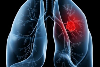 saiba-o-que-e-adenocarcinoma-pulmonar,-cancer-que-atinge-o-papa