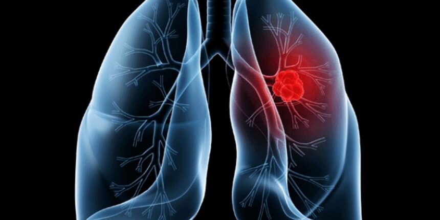 saiba-o-que-e-adenocarcinoma-pulmonar,-cancer-que-atinge-o-papa