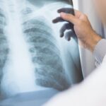 anvisa-aprova-novo-medicamento-para-cancer-de-pulmao-avancado