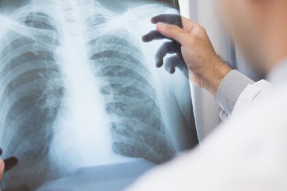 anvisa-aprova-novo-medicamento-para-cancer-de-pulmao-avancado